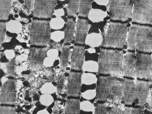 M,61y. | myopathy - steatosis M,61y. | myopathy - steatosis